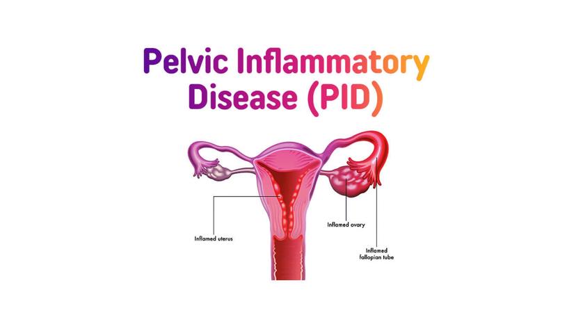 Pelvic Inflammatory Disease (PID): Causes, Symptoms, and Treatment for Fertility Preservation