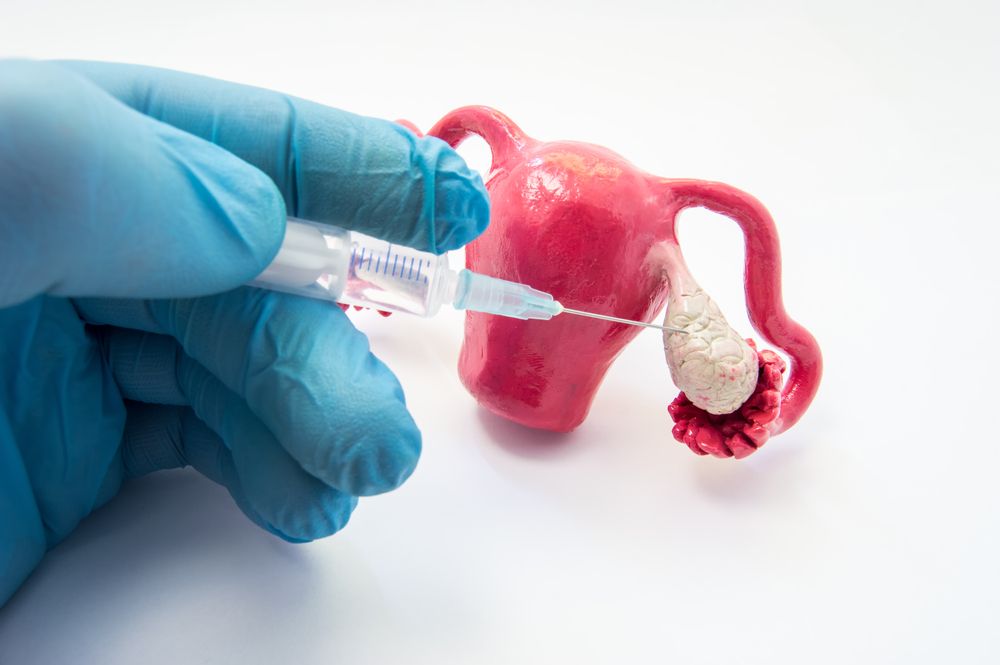 Understanding Ovulation Induction: A Key To Overcoming Infertility