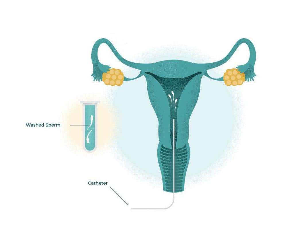Intrauterine Insemination (IUI): A Simple And Effective Fertility Solution